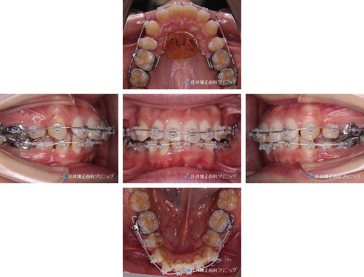 症例集 | 奈良市の矯正歯科「氏井矯正歯科クリニック」