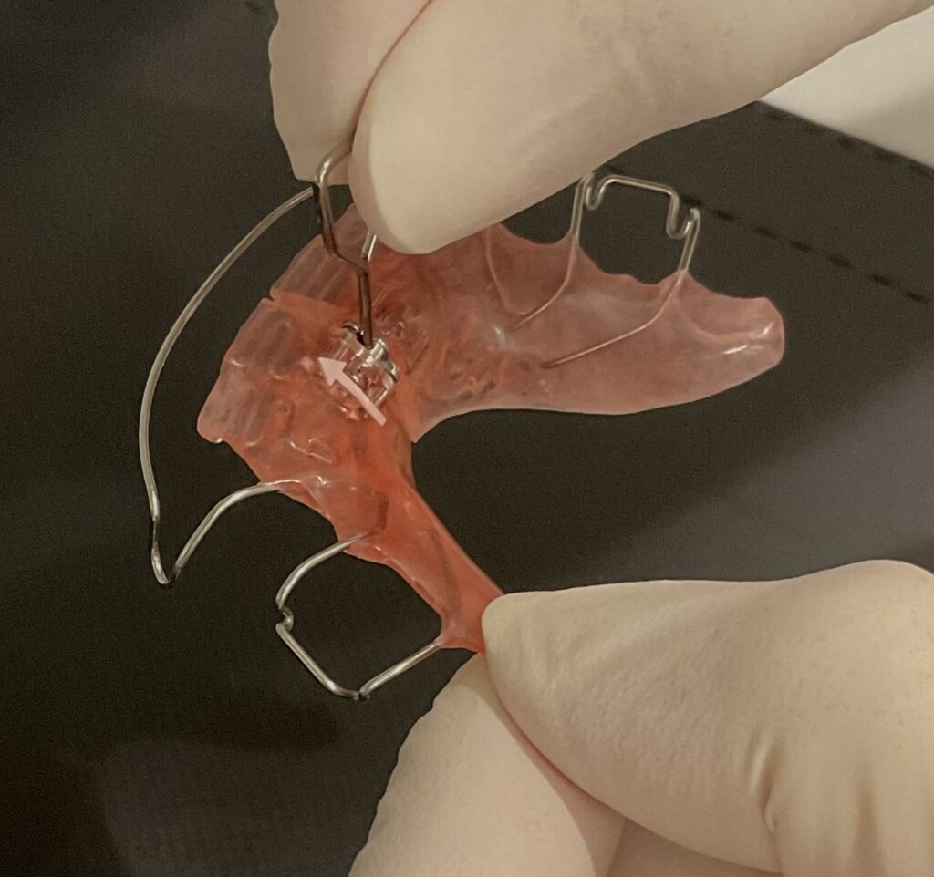 小児矯正で使う拡大床のネジを回す手順|奈良の矯正歯科