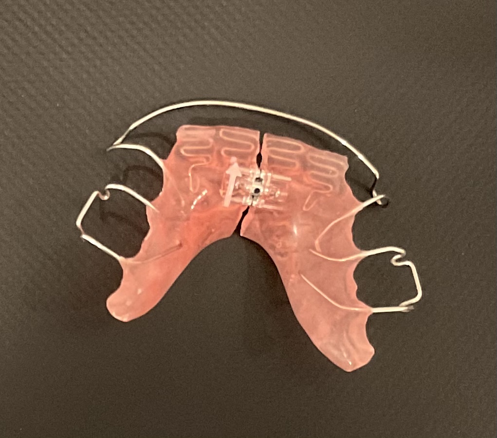 上顎を広げて歯並びを整える拡大床の写真|奈良の矯正歯科