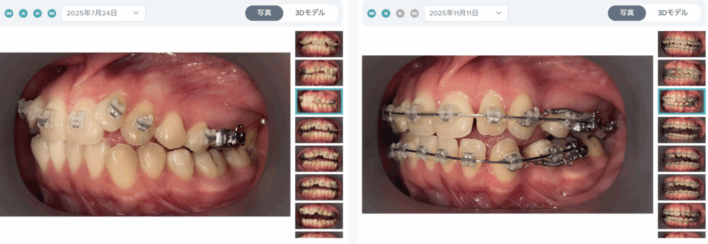 矯正治療　段階
