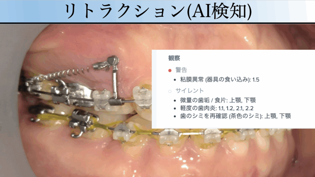 デンタルモニタリングAIによるリトラクション治療の検知画像。バネの異常や粘膜への巻き込みを早期に発見し、矯正治療の安全性を高める仕組みを解説。