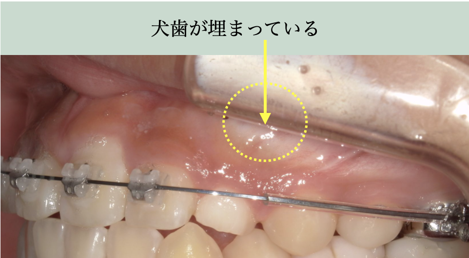 永久犬歯が歯ぐきに埋伏している症例写真。早期発見と矯正治療の重要性を解説。