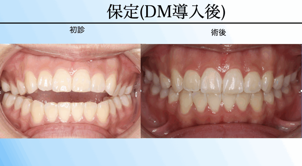 デンタルモニタリング導入後の保定治療。初診時と術後の歯並びを比較し、AIがリテーナー不適合や隙間を検知する仕組みを解説。