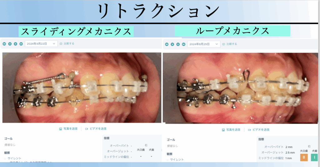 矯正治療におけるリトラクションの比較写真。スライディングメカニクスとループメカニクスの違いを示し、デンタルモニタリングによる適応効果を検証。