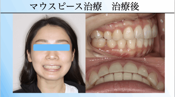 マウスピース治療　治療後