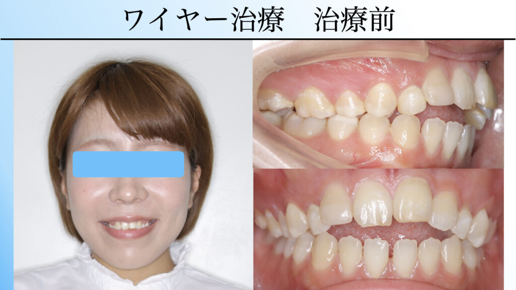 開咬はマウスピース矯正で治せる?|費用・期間・ワイヤー矯正との違い