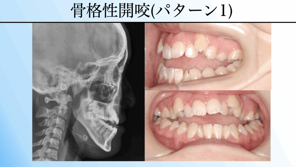 開咬の矯正は保険適用される?|自費との違いと判断ポイント