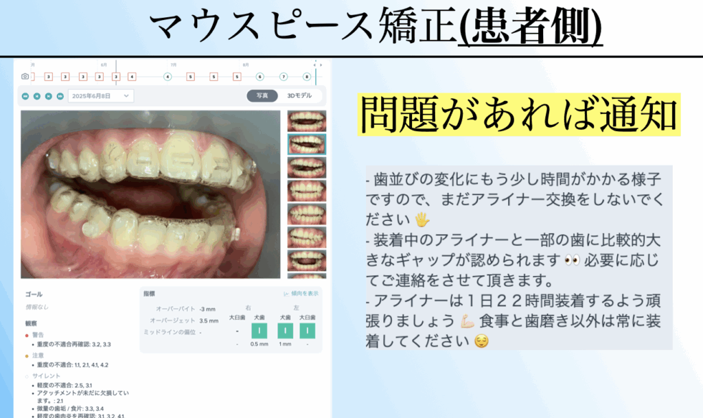 デンタルモニタリングを使ったマウスピース矯正。患者側はアプリ通知で装置の不適合や交換時期を確認でき、安心して治療を継続可能