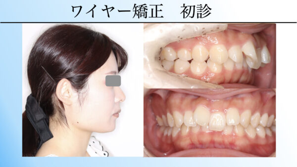 ワイヤー矯正　初診