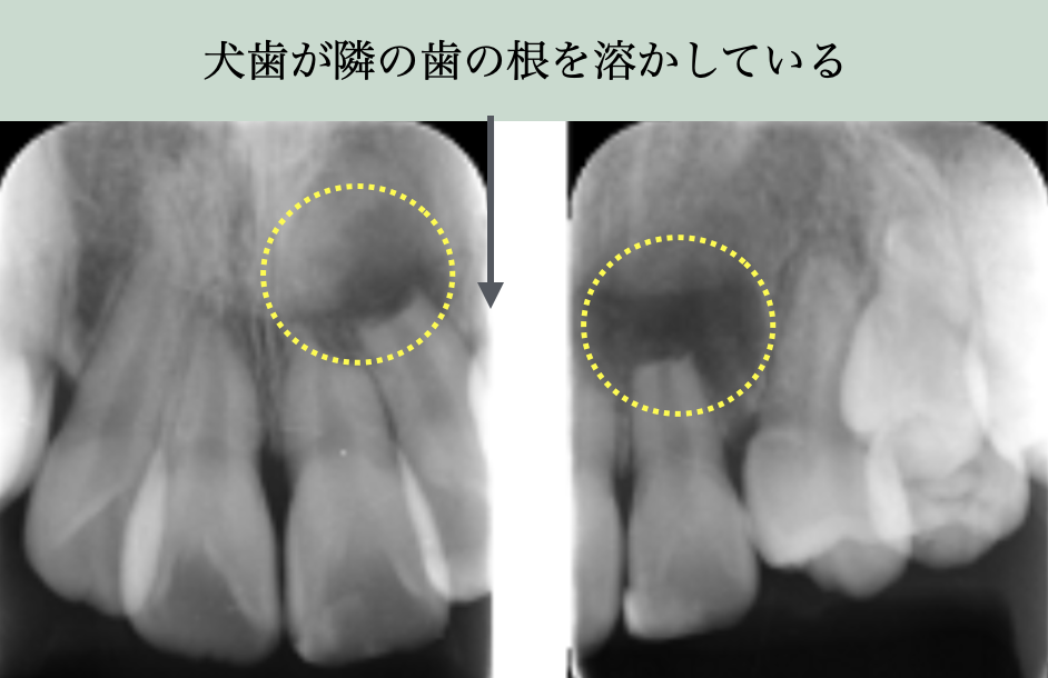 埋伏犬歯が隣接歯の歯根を溶かしている状態を示す歯科レントゲン。歯根吸収リスクの注意喚起