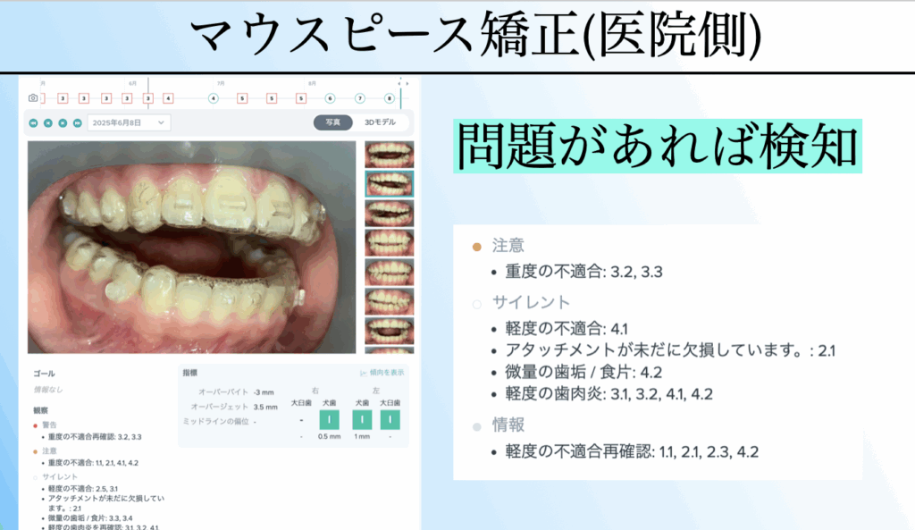 奈良の矯正歯科におけるデンタルモニタリング。医院側ではAIが装置不適合や歯肉炎の兆候を検知し、早期対応が可能になるシステム画面。
