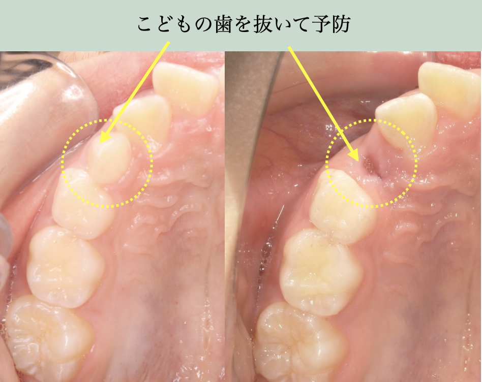 小学生の矯正治療で乳歯を抜歯し、永久犬歯の萌出スペースを確保する症例写真。