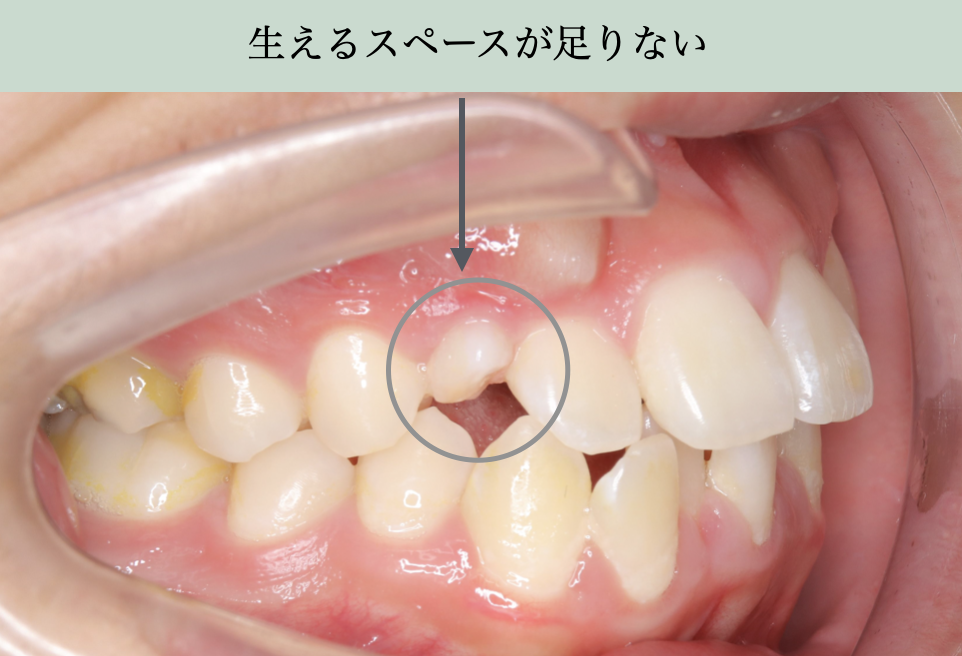 小学生の犬歯が生えるスペース不足で歯列に収まらない症例写真。犬歯が正しく萌出できない原因を解説。