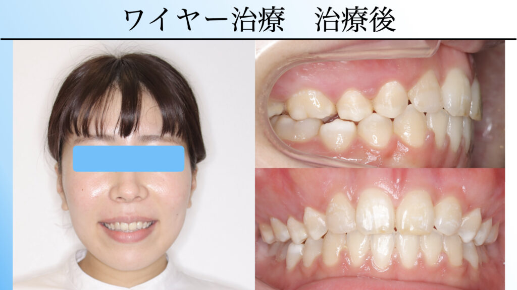 開咬はマウスピース矯正で治せる?|費用・期間・ワイヤー矯正との違い