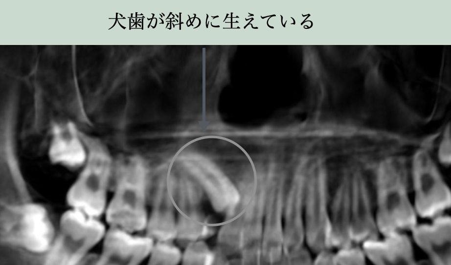 犬歯が斜め方向に埋伏している歯科レントゲン画像。放置すると隣の歯を圧迫・吸収するリスクを説明