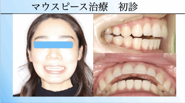 マウスピース治療　初診