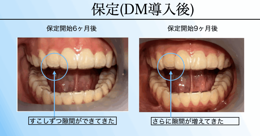 保定中のデンタルモニタリング経過観察。6ヶ月後と9ヶ月後の歯並びを比較し、AIが後戻りの兆候を検知して再治療提案につなげた症例。