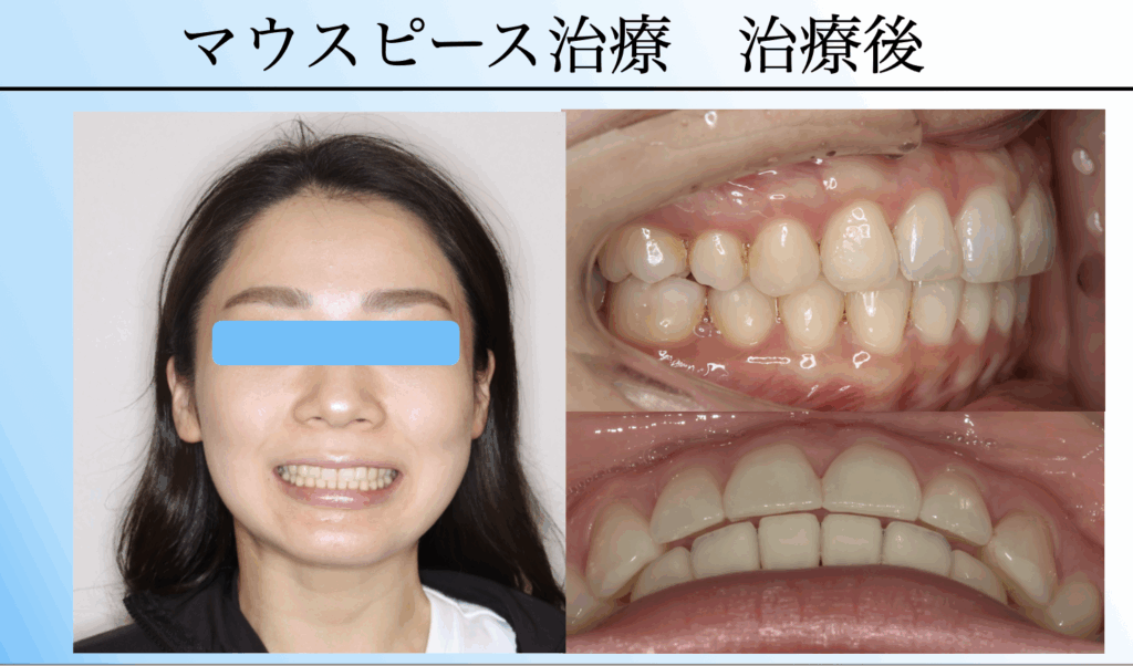 開咬はマウスピース矯正で治せる?|費用・期間・ワイヤー矯正との違い