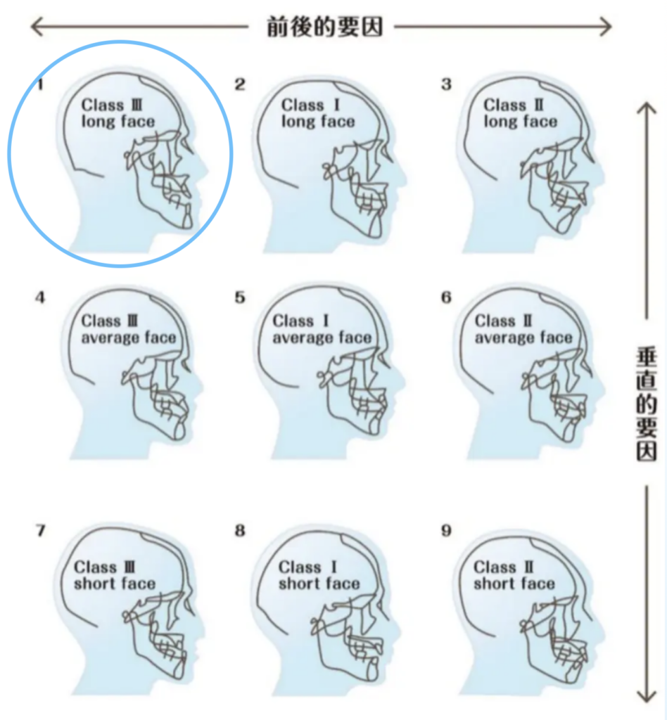 開咬を診断するための9つの骨格分析パターン|矯正歯科での分類図