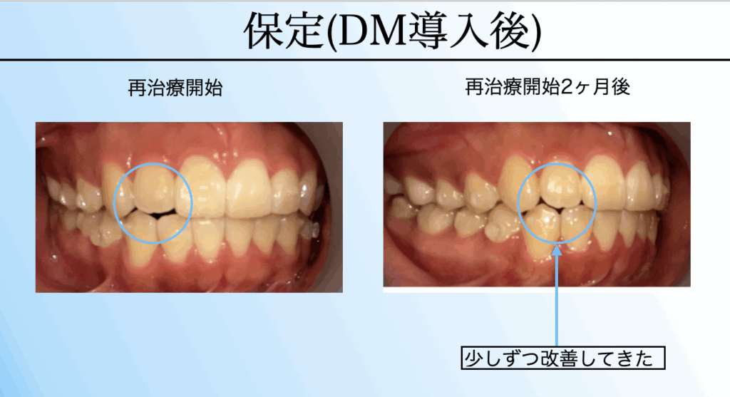 奈良の矯正歯科における保定治療(デンタルモニタリング導入後)の経過比較。再治療開始時と2ヶ月後の写真で、AIチェックにより少しずつ改善している様子を解説。