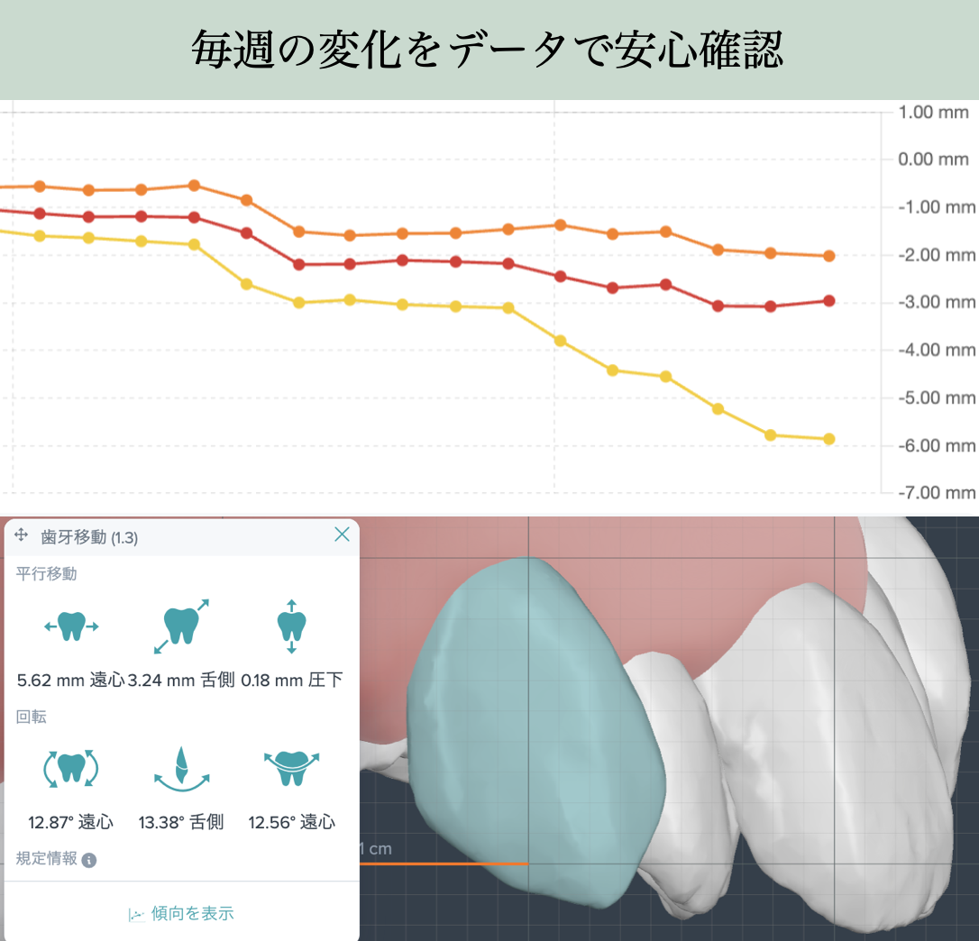 AIによる歯の動きの数値データと治療計画進捗グラフ