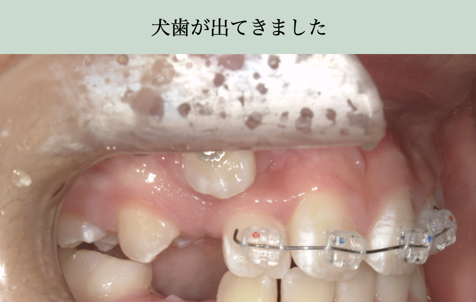 矯正治療により埋伏犬歯が徐々に萌出してきた症例写真。ブラケット装置で正しい位置へ誘導