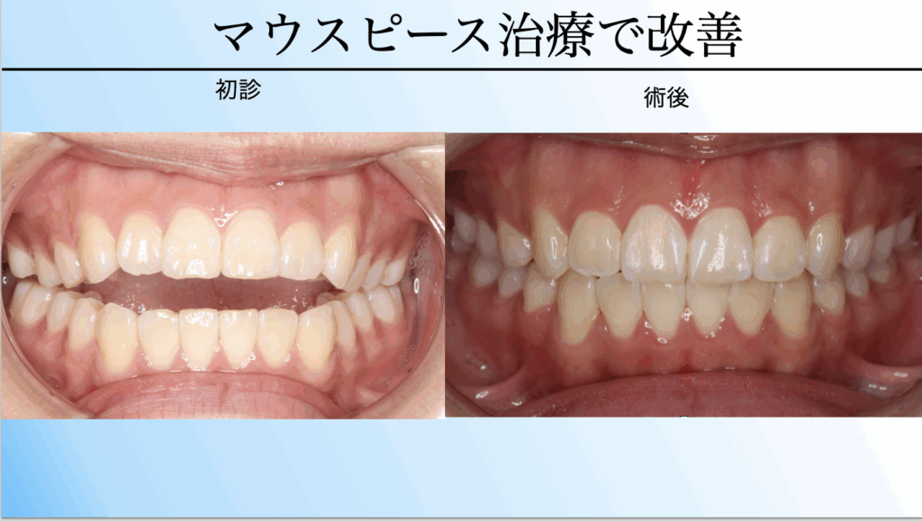 開咬をマウスピース矯正で改善した症例|インビザラインによるBefore After
