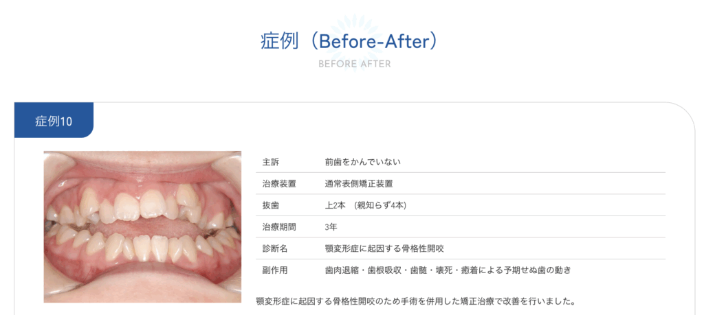 開咬の矯正治療症例写真|Before Afterで見る噛み合わせ改善例