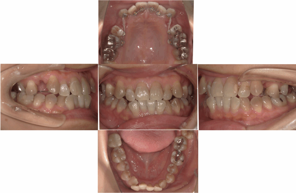 八重歯ハーフリンガル