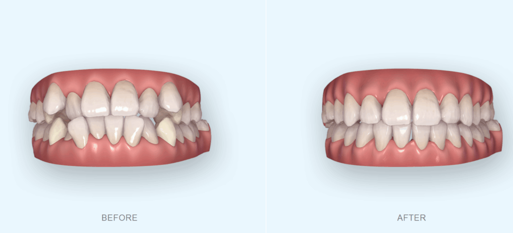 八重歯ハーフリンガル