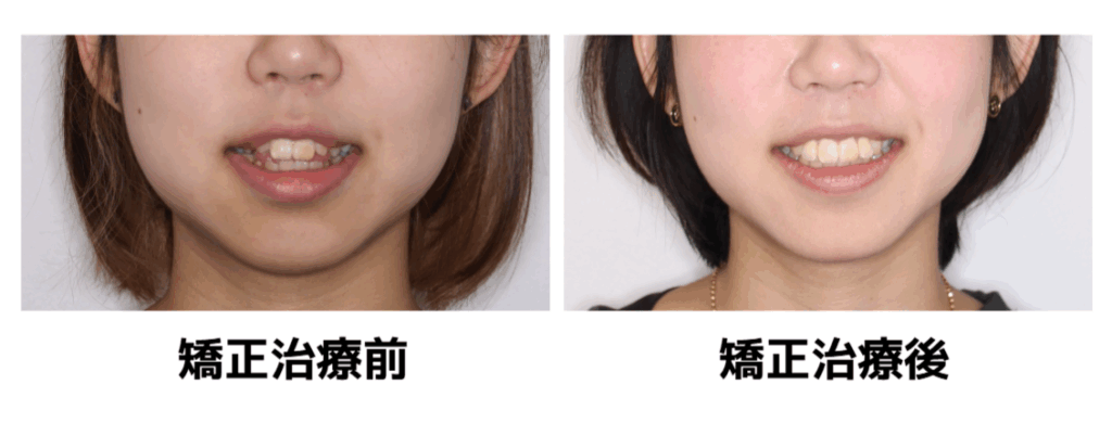矯正治療ビフォーアフター
