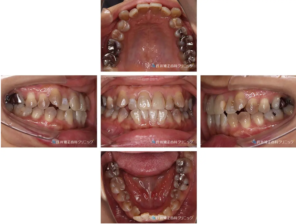 八重歯ハーフリンガル