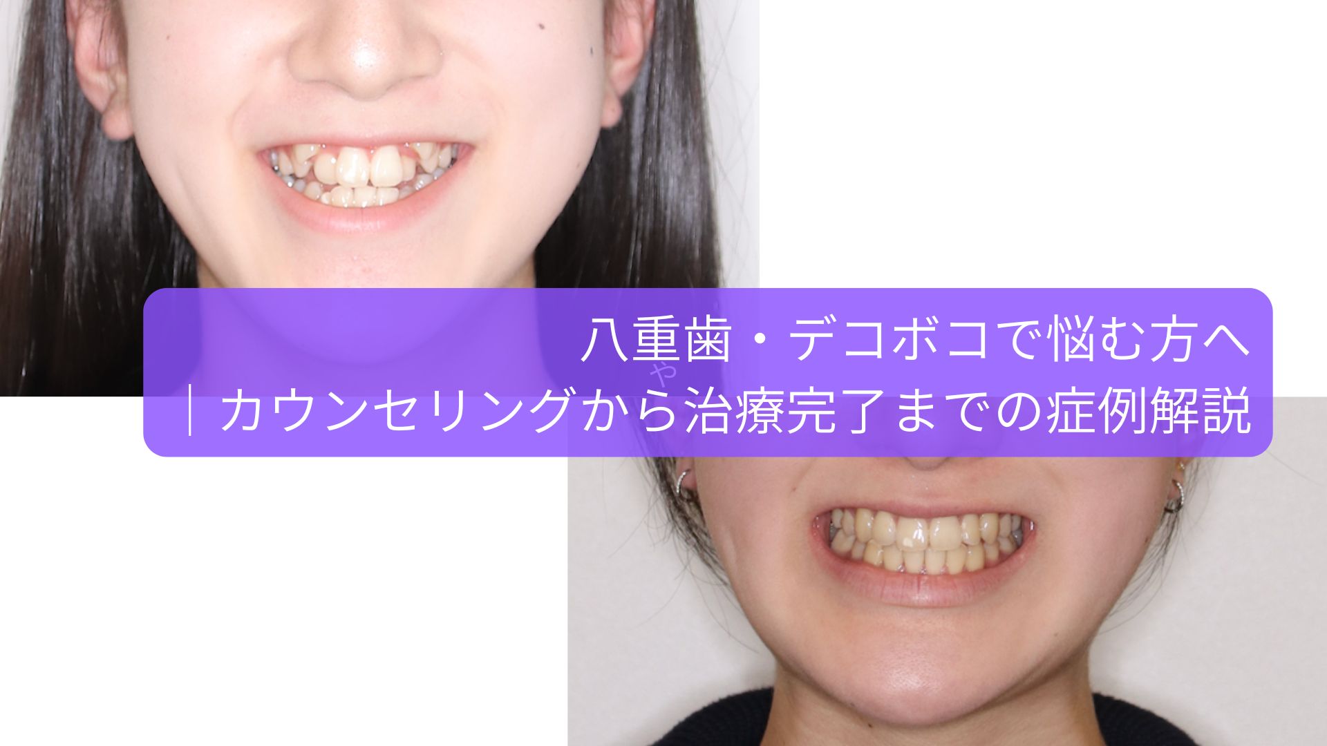 八重歯の矯正治療