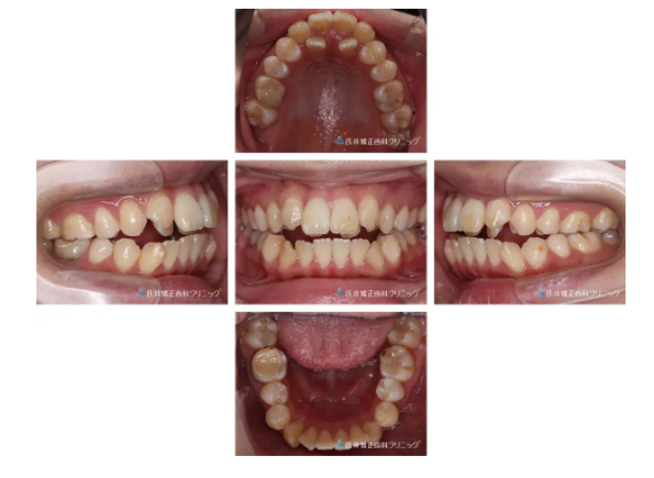 矯正歯科 症例画像