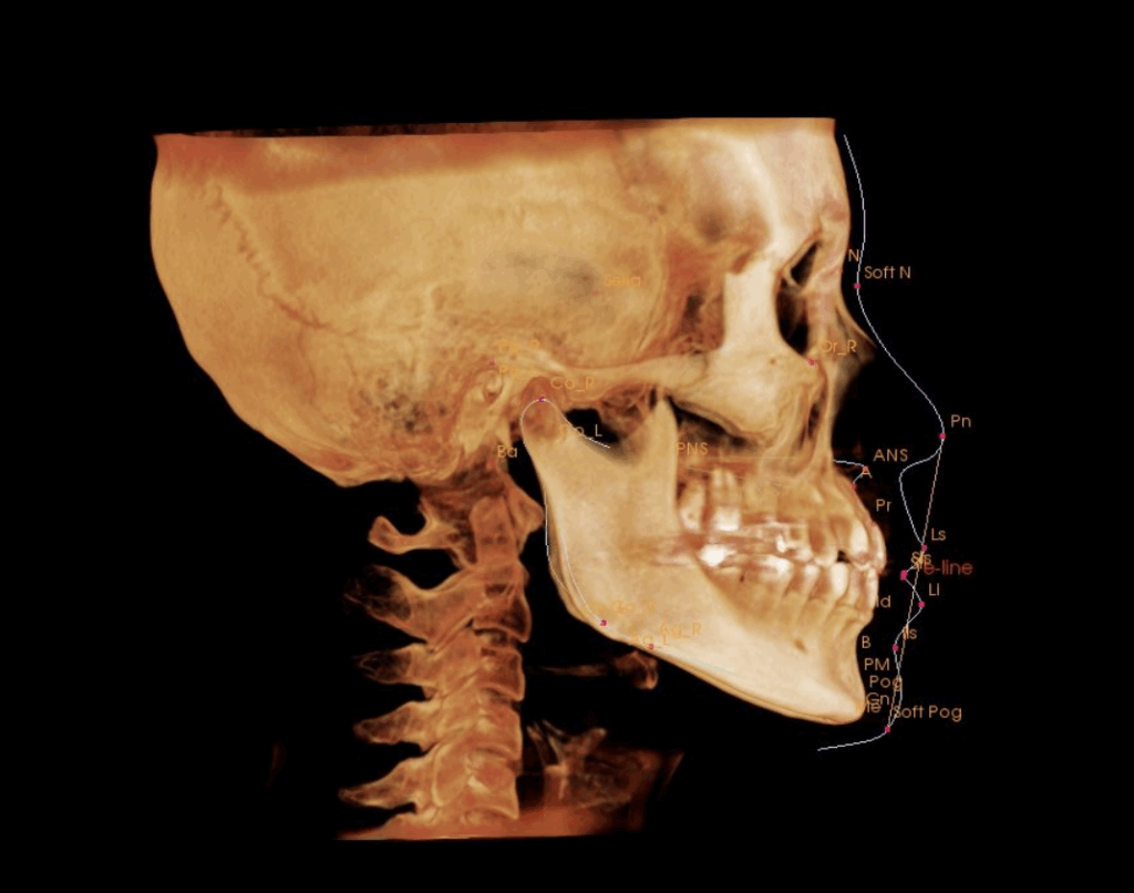 八重歯ハーフリンガル