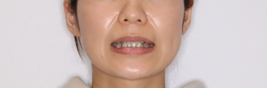 八重歯ハーフリンガル