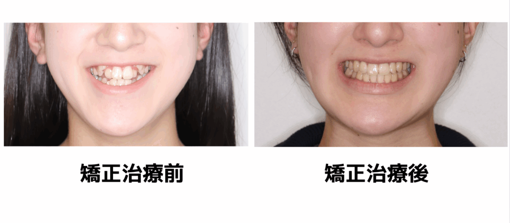 八重歯の矯正治療前後の比較。左は上の犬歯が前に出て歯が重なっている治療前、右は歯並びが整い口元がすっきりした矯正治療後の笑顔