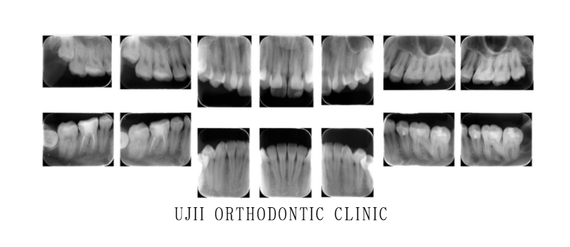 矯正治療デンタル