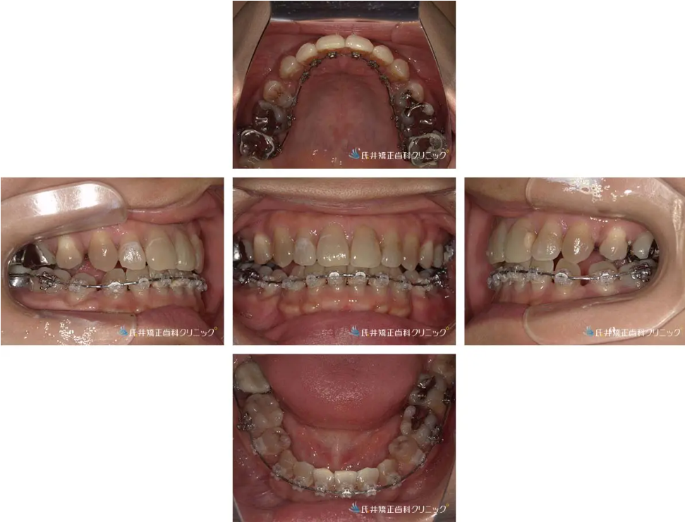 八重歯ハーフリンガル