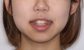 矯正歯科 症例画像