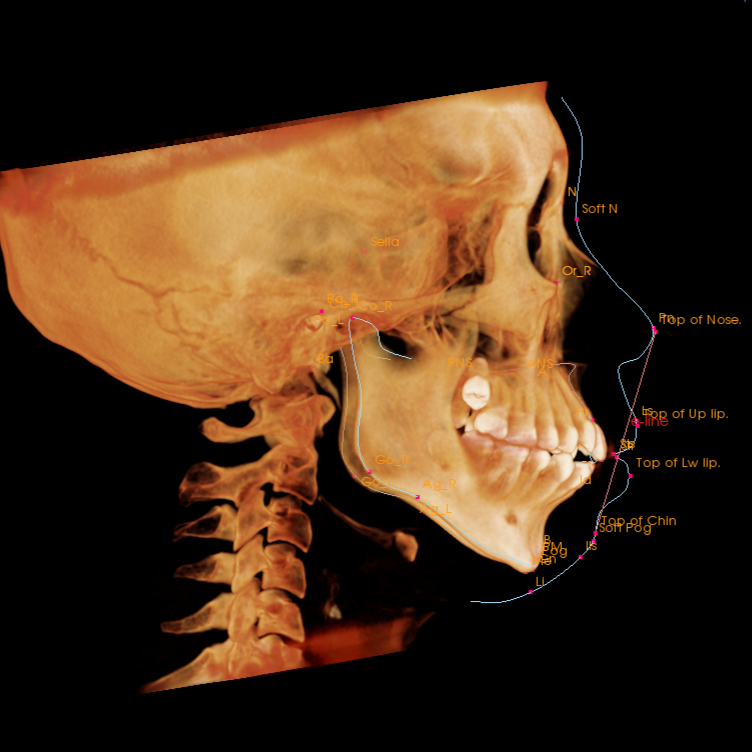 矯正歯科 CT画像