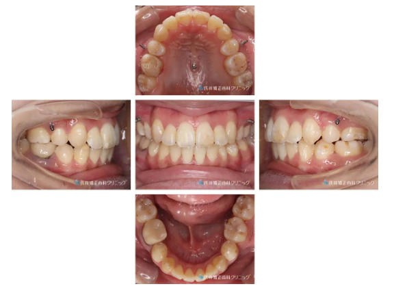 矯正治療 症例