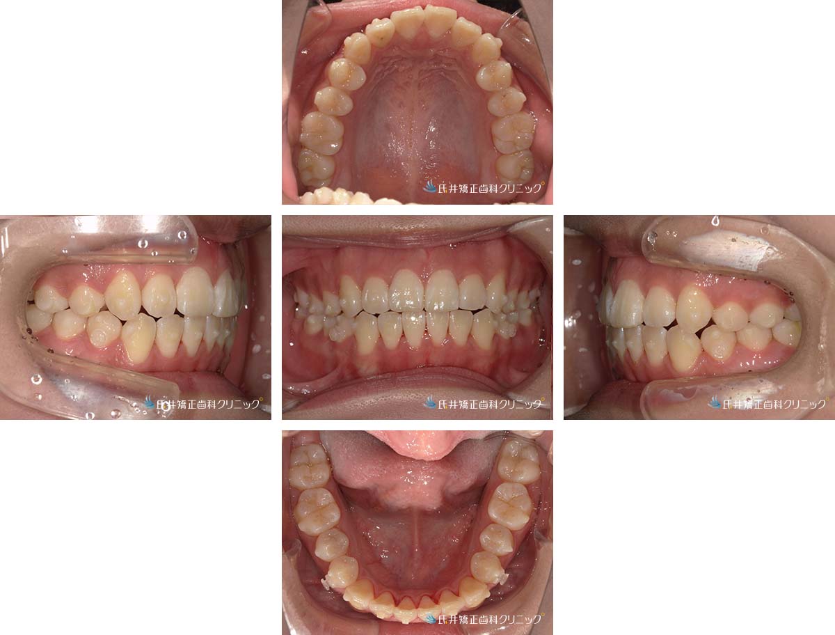 治療中(3ヶ月後)