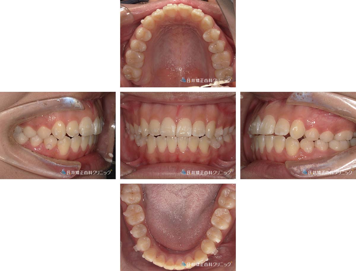 治療中(6ヶ月後)