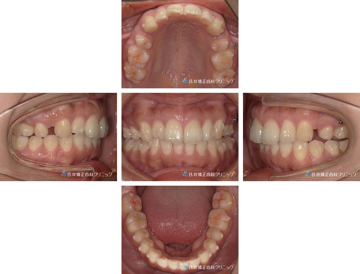 治療中(6ヶ月後)