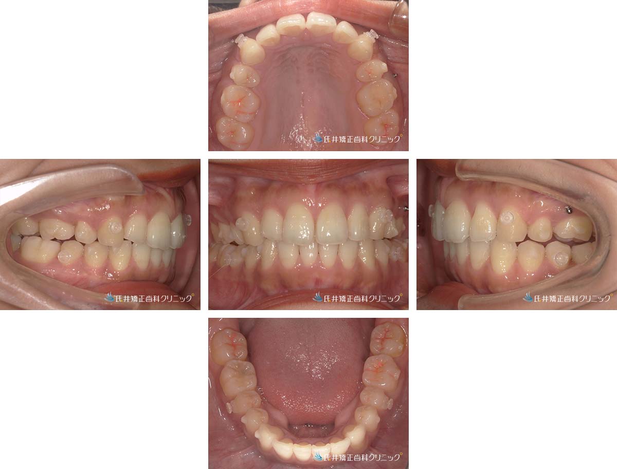 治療中(12ヶ月後)