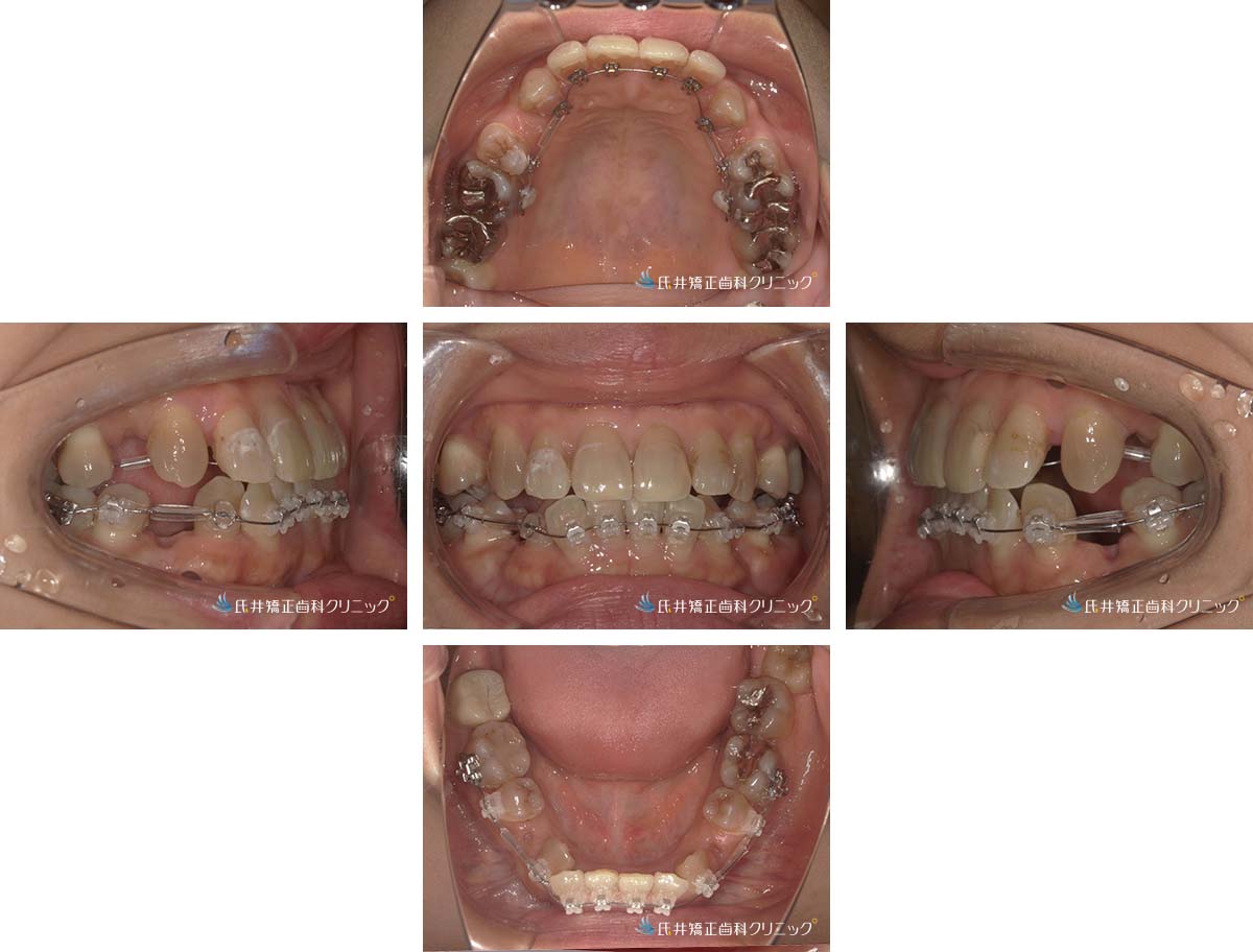 治療中(4ヶ月後)