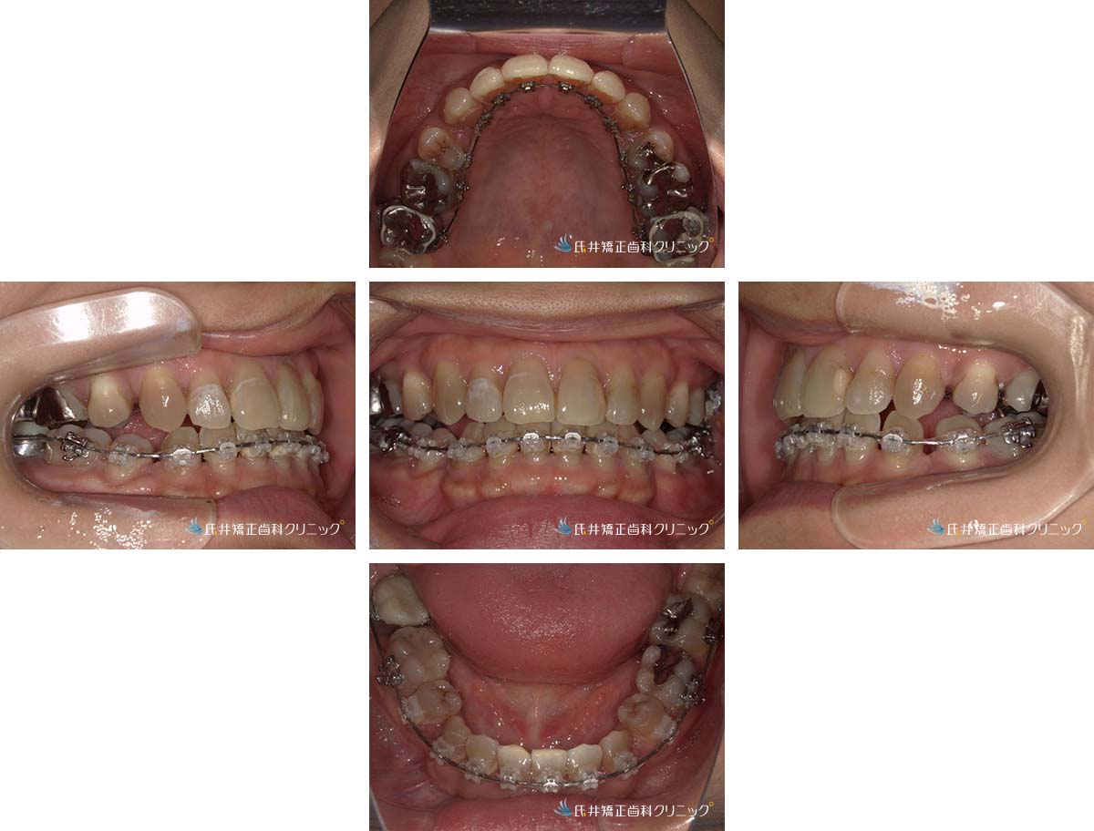 治療中(12ヶ月後)