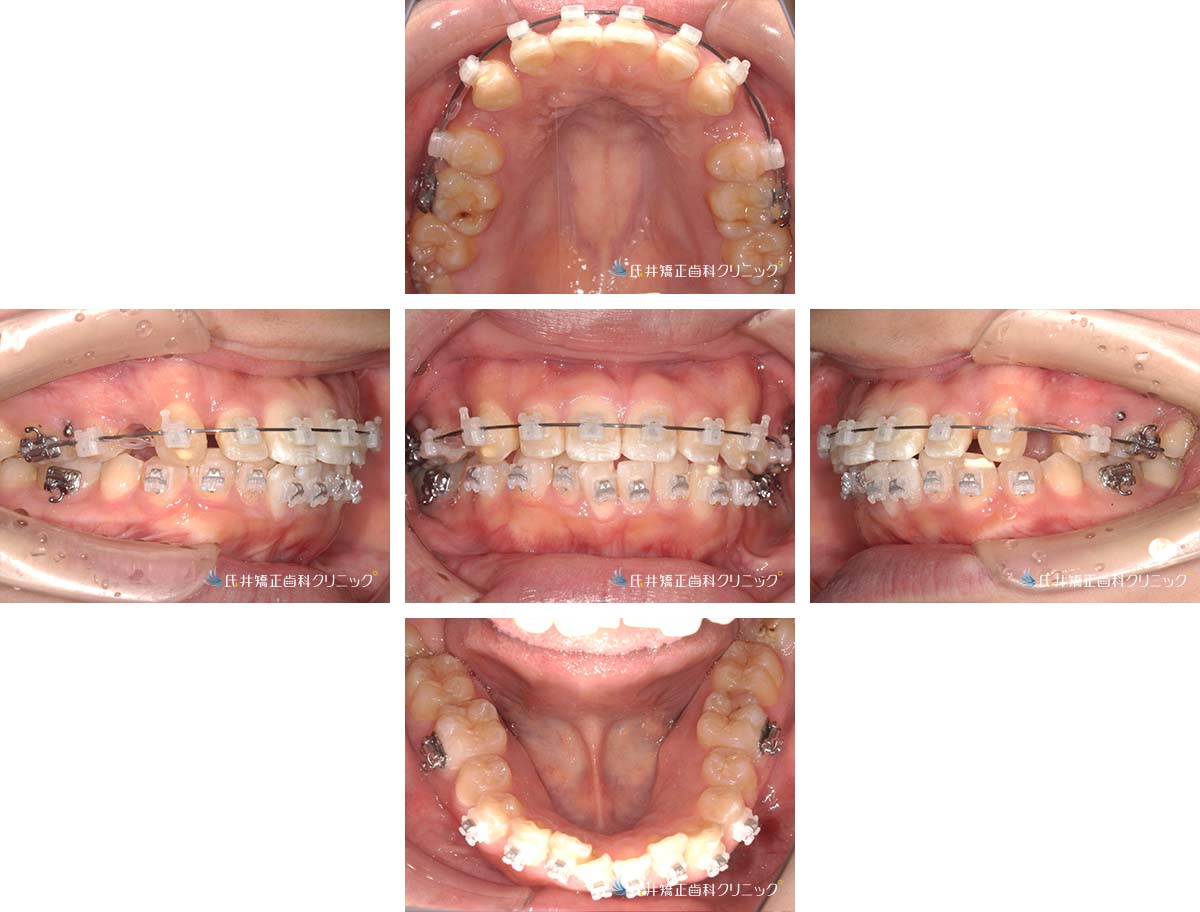 治療中(3ヶ月後)