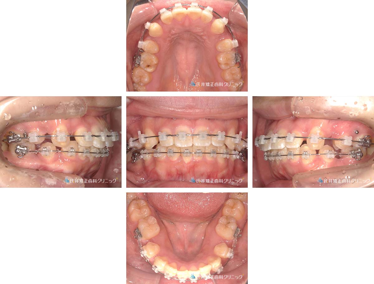 治療中(6ヶ月後)